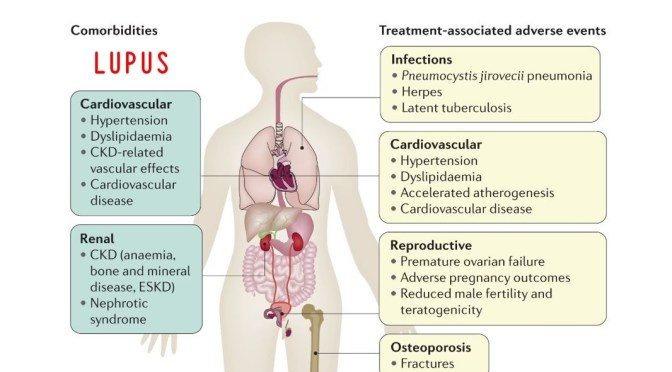 Infographic: Causes And Treatments Of Lupus