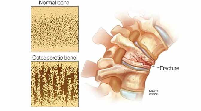 Osteoporosis: What What Women Need To Know