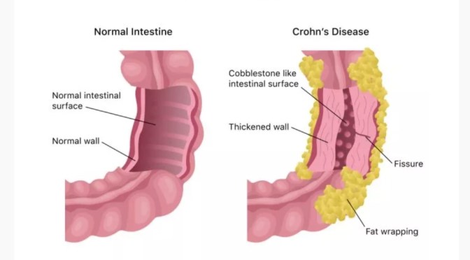 Chronic Inflammation: What Is Crohn’s Disease?
