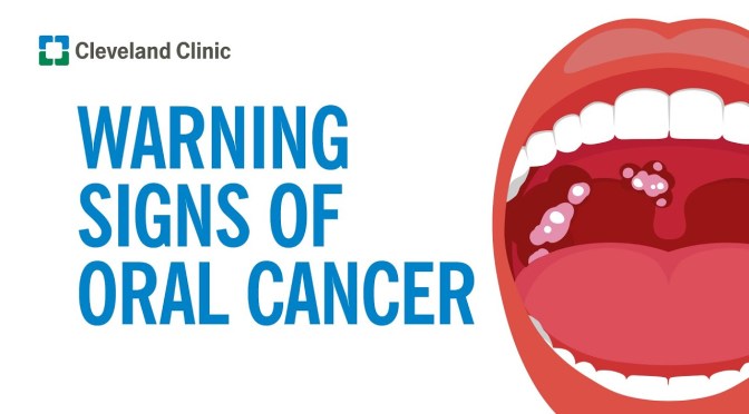Cleveland Clinic: How To Prevent Oral Cancer