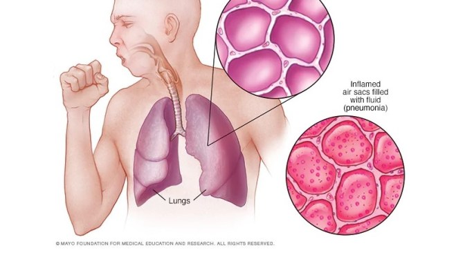 Infographic: Diagnosis & Treatment Of Pneumonia