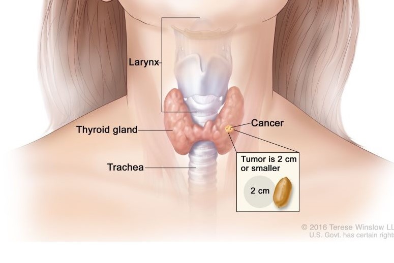 Mayo Clinic: Thyroid Cancer Explained (Video) | Doctors Without