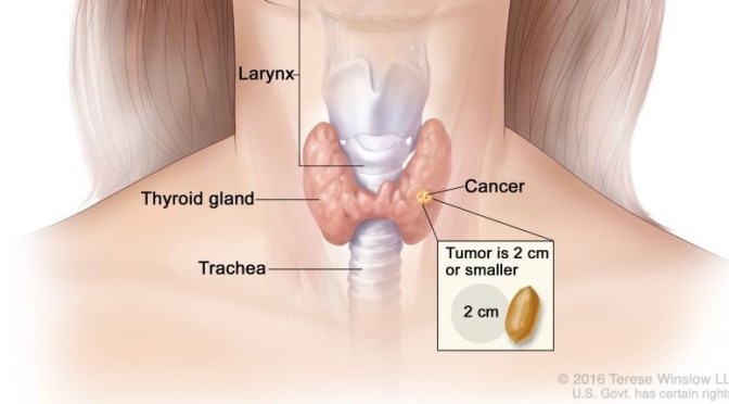 Mayo Clinic: Thyroid Cancer Explained (Video)