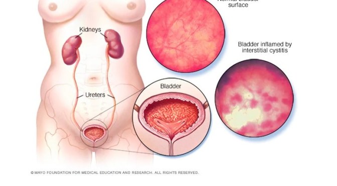 Diagnosis: What Is Painful Bladder Syndrome? (Q&A)