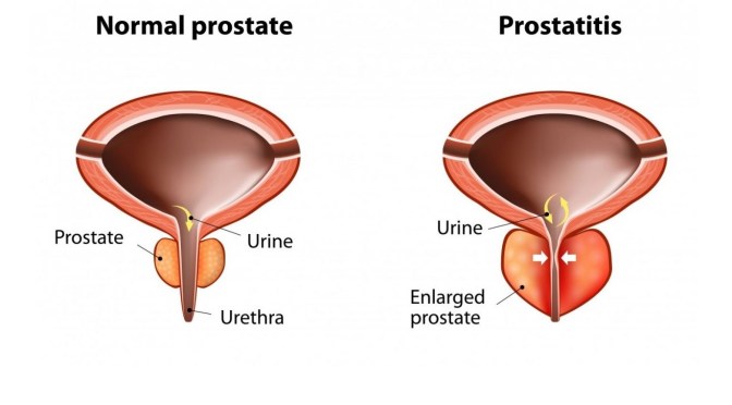 Dr. C’s Journal: Signs & Symptoms Of Prostatitis