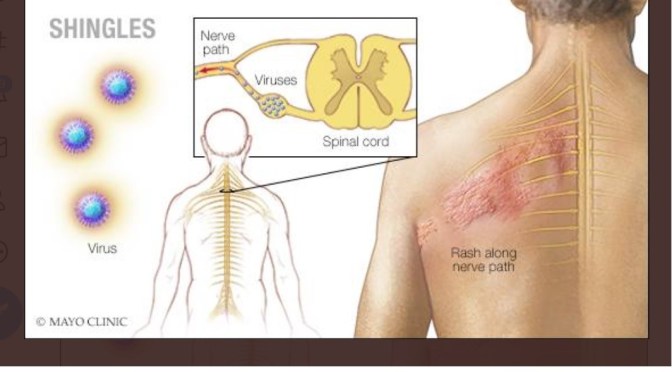 Viral Infections: The Risks And Causes Of Shingles