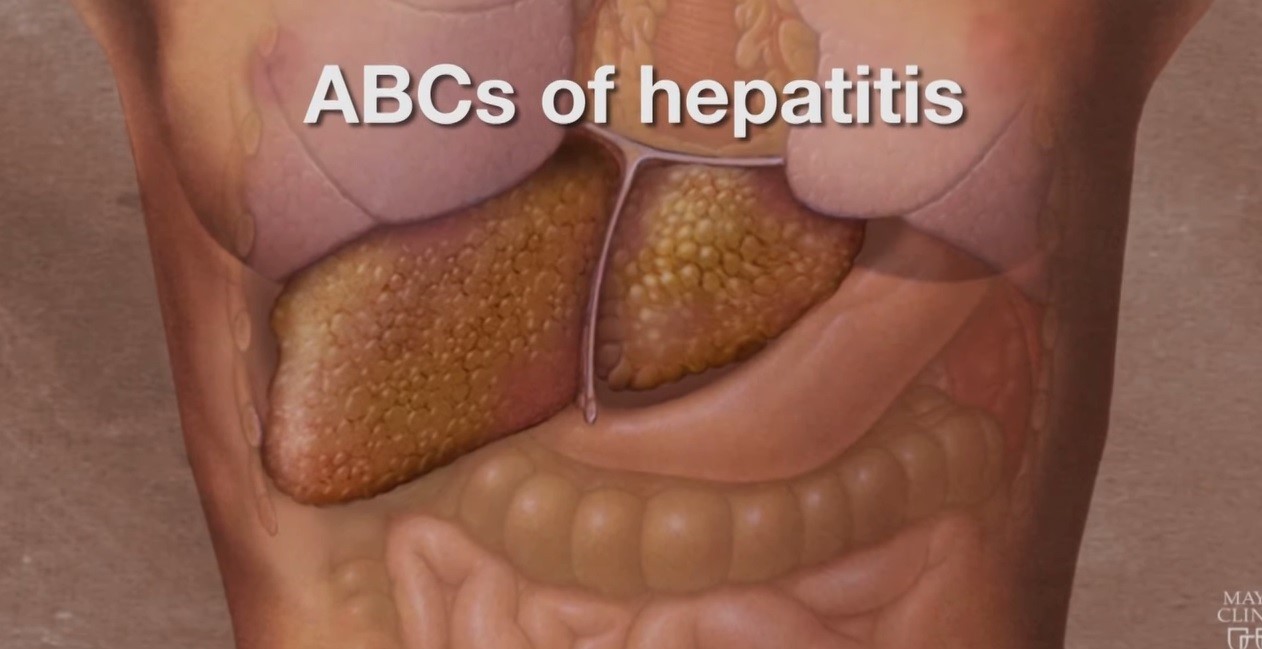 Medicine: The ABCs Of Hepatitis (Mayo Clinic) | Doctors Without Waiting ...