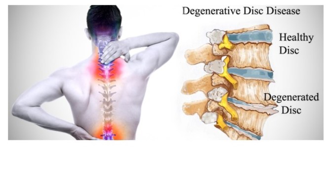 Aging: Degenerative Disk Disease Surgical Options
