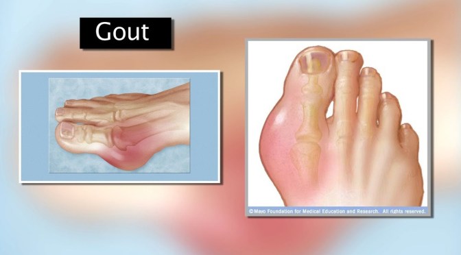 Arthritic Conditions: The Signs & Symptoms Of Gout