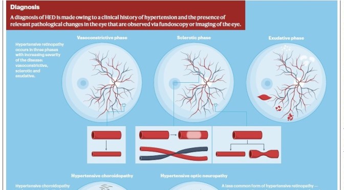 Diagnosis: Hypertensive Eye Disease (Infographic)