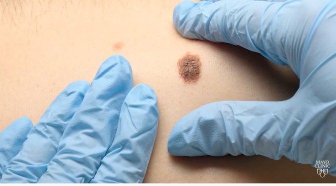Melanoma: Men Have Higher Mortality Rates