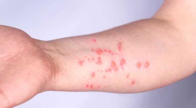 Diagnosis: The Signs And Symptoms Of Monkeypox