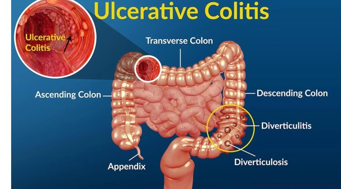 Inflammation: Treating Ulcerative Colitis (UC)