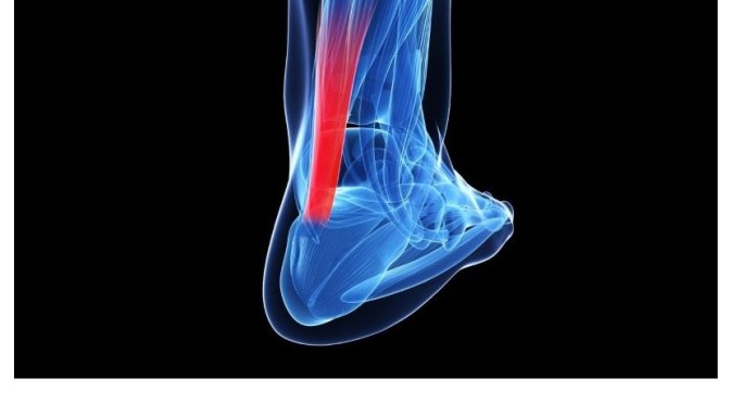 Dr. C’s Journal: What Is Achilles Tendinitis?