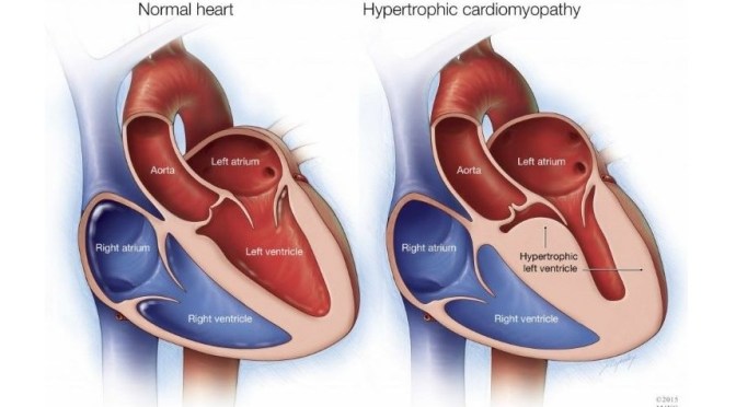 Heart Disease: Symptoms & Types Of Cardiomyopathy