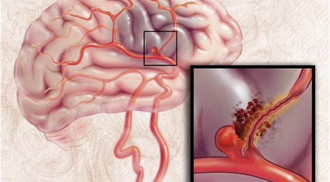 Strokes: Subarachnoid Hemorrhage Treatment