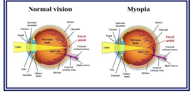 Eye Disorders: The Types And Causes Of Myopia