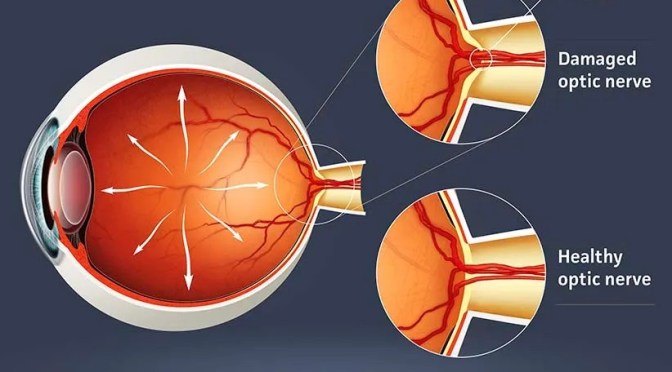 Glaucoma: The Risks Of Ocular Hypertension