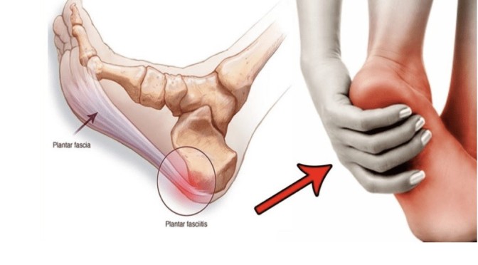 Dr. C’s Journal: Plantar Fasciitis And Foot Pain