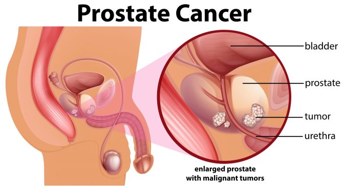 Prostate Cancer: Seven Top Questions Answered