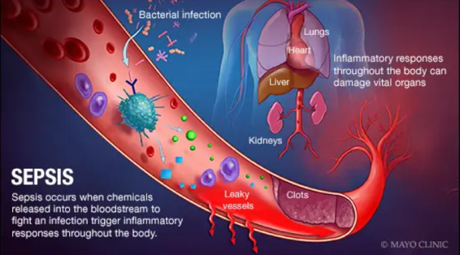 Medical Conditions: Signs And Treatment Of Sepsis