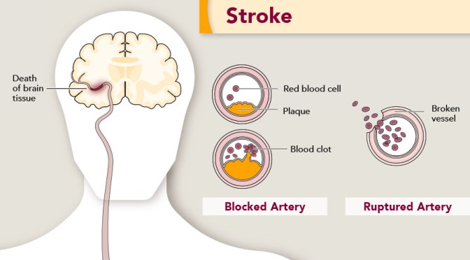Stroke: Long Periods Of Sitting Increases Risks