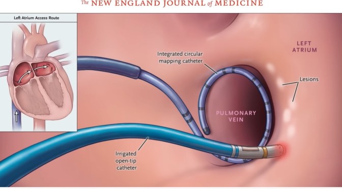 NEJM: Atrial Fibrillation And Catheter Ablation