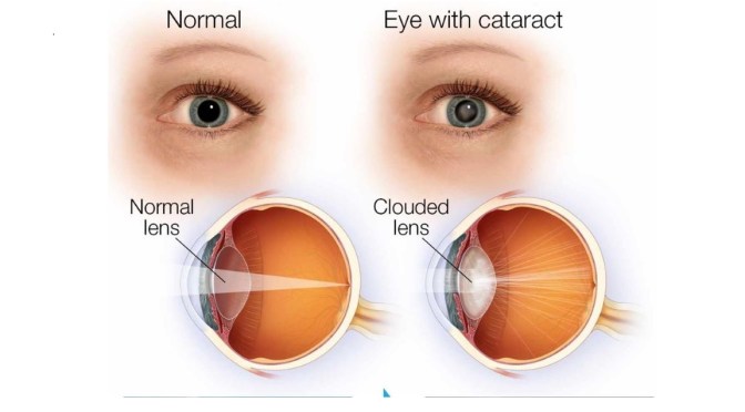 Eye Health: The Signs And Diagnosis Of Cataracts