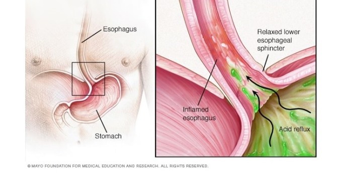 Diagnosis: Gastro – Oesophageal Reflux