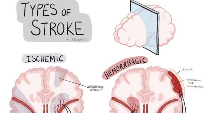 The Two Types Of Stroke: Ischemic & Hemorrhagic