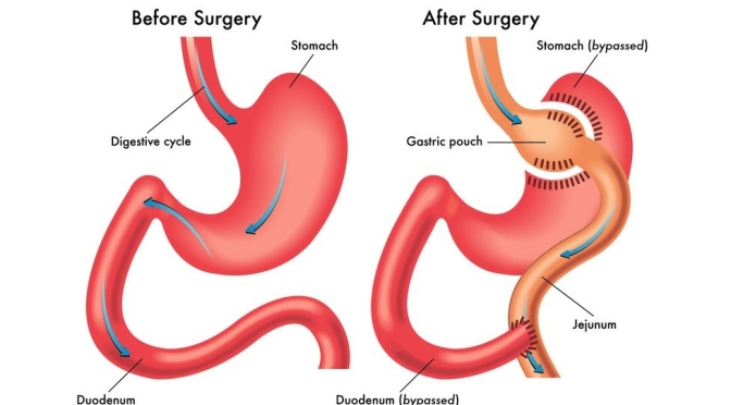 Weight Loss: Bariatric Surgery Explained (UCLA)