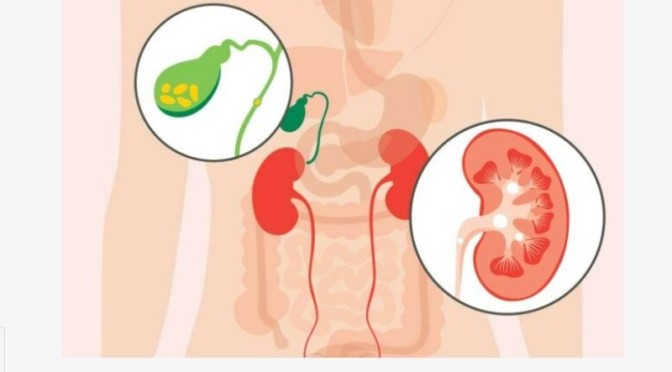 Digestive: Gallstones VS Kidney Stones Symptoms