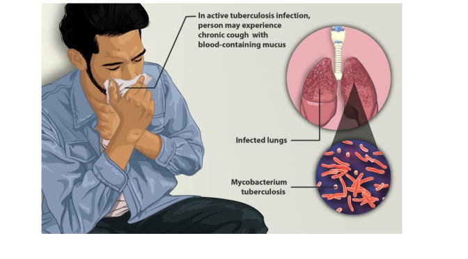 Dr. C’s Journal: Some Facts Regarding Tuberculosis