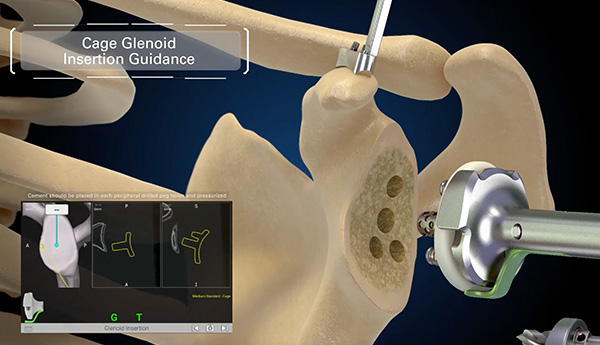 Reviews: New Shoulder Replacement Surgeries