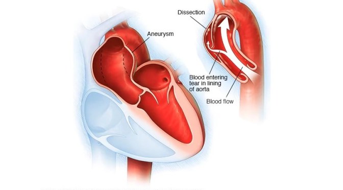 Heart Disease: Thoracic Aortic Aneurysm Risks