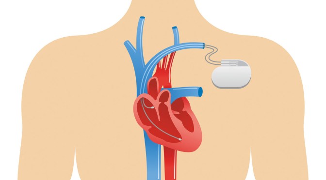 Heart Health: Function & Benefits Of Pacemakers