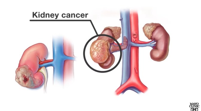 Kidney Cancer: What Are The Treatment Options?