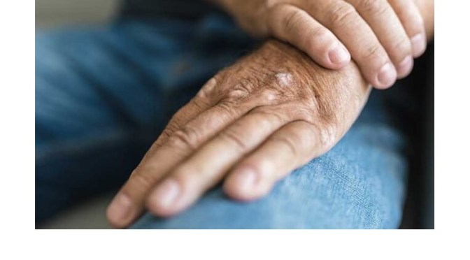 Review: Psoriatic Arthritis Flare-Up Signs & Symptoms