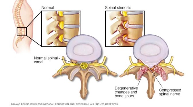 Spinal Stenosis: Causes &Treatment (Mayo Clinic)