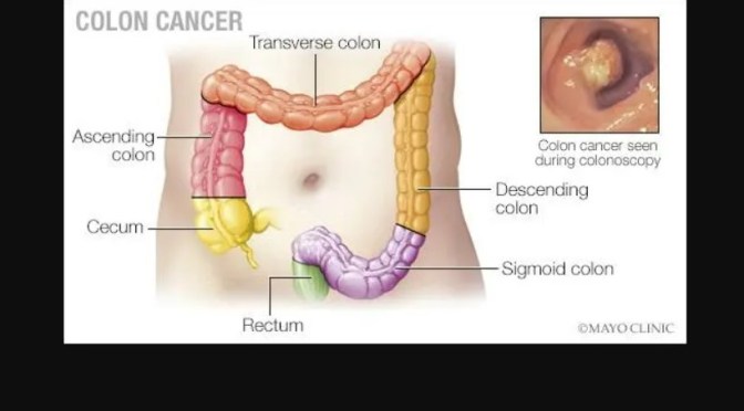 Colon Cancer Options: Intraoperative Radiation Therapy Vs Radiation