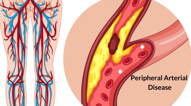 Circulatory Conditions: Peripheral Artery Disease