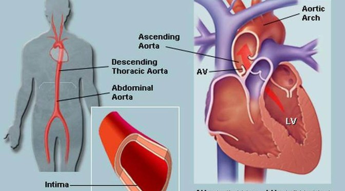 Heart Disease: A Surgeon’s View Of Aorta Surgery